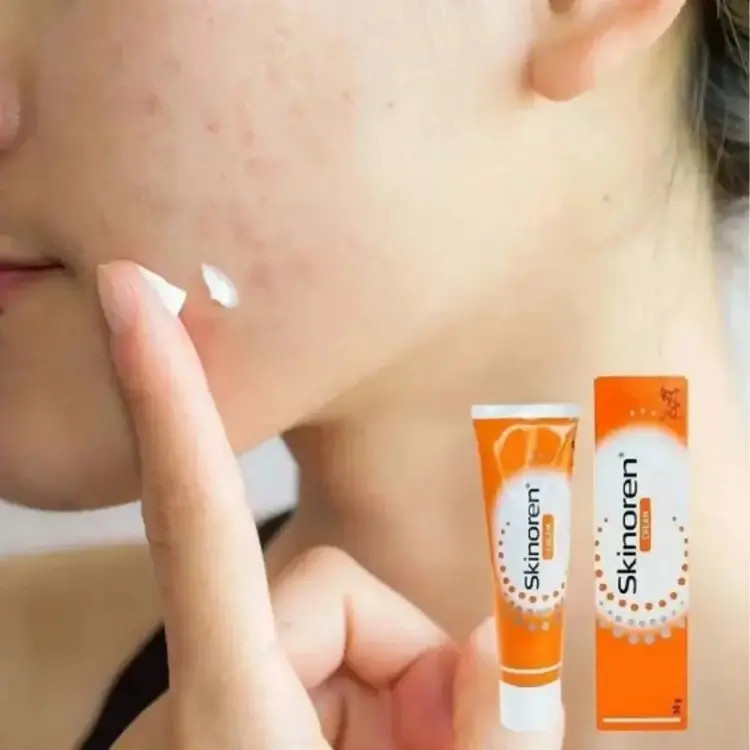 کرم آزلائیک اسید20% اسکینورن درمان جوش، جای جوش و لک